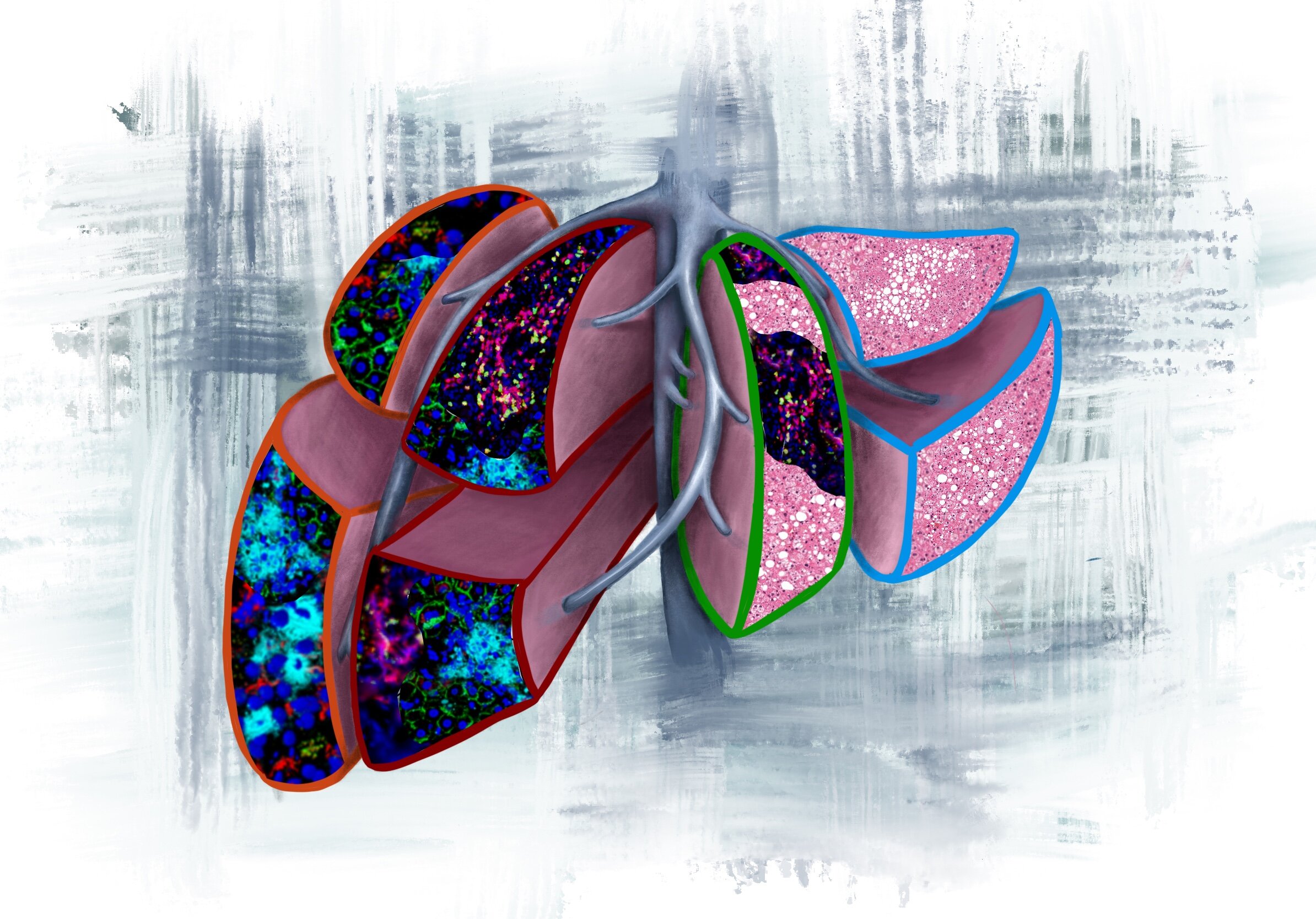 New predictors of metastasis in patients with early-stage pancreatic ...